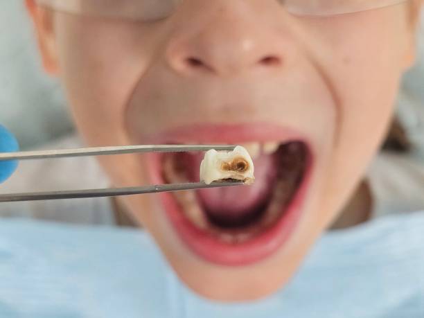 Best Emergency Wisdom Teeth Removal in Dillingham, AK